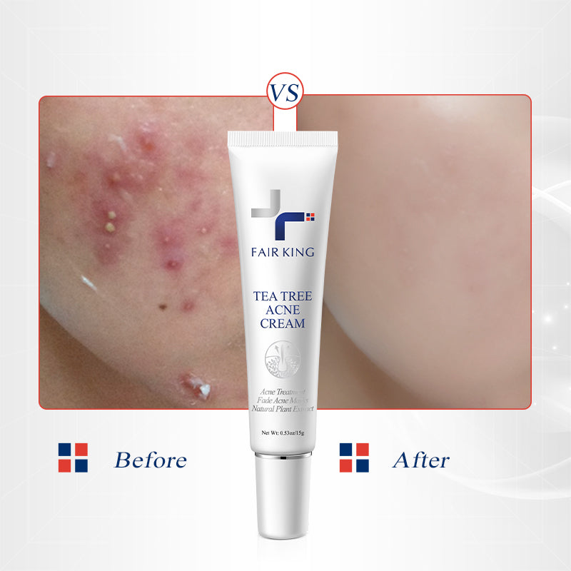 FAIR KING TEA TREE ACNE CREAM